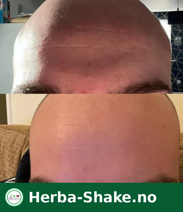 Herbalife Collagen Skin Booster – synlige hudforbedringer